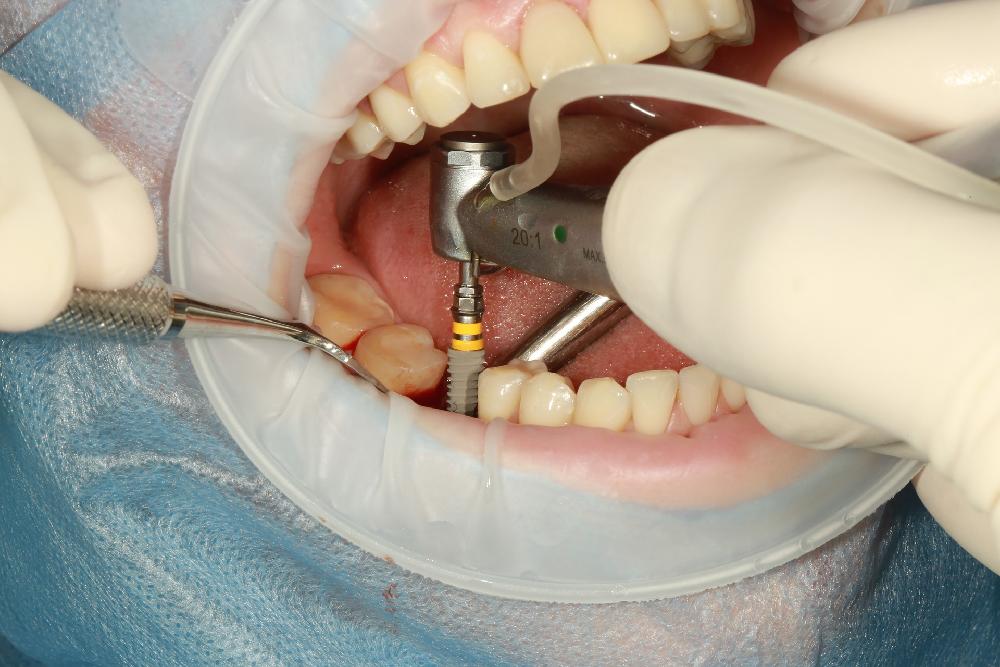 Jak dbać o implanty zębowe?
